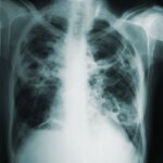 "Tackling the Troubling Surge: New York's Battle Against Rising Tuberculosis Cases"newyork,tuberculosis,publichealth,diseasecontrol,healthcare,epidemic,infectiousdisease,publicsafety,healthcaresystem,publicawareness